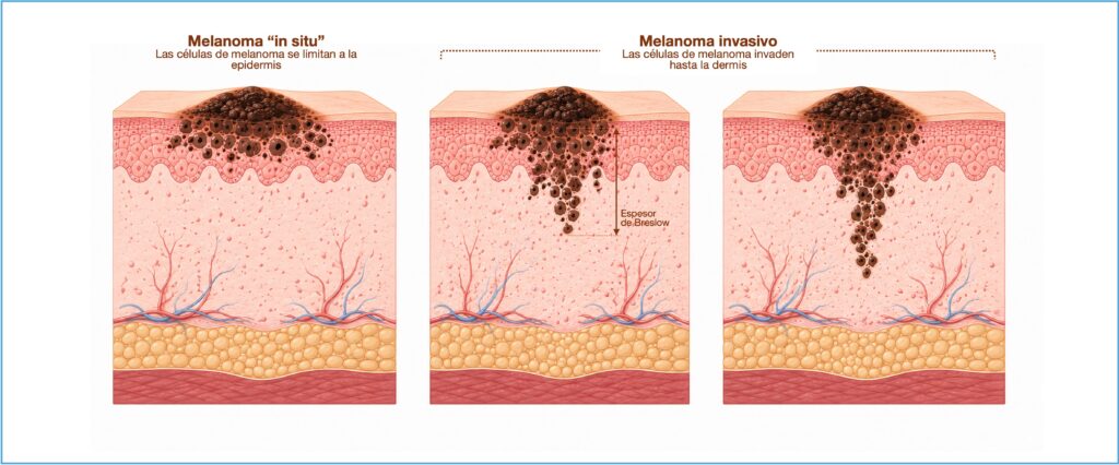 Esquema del melanoma in situ y melanoma invasivo mostrando el espesor de Breslow