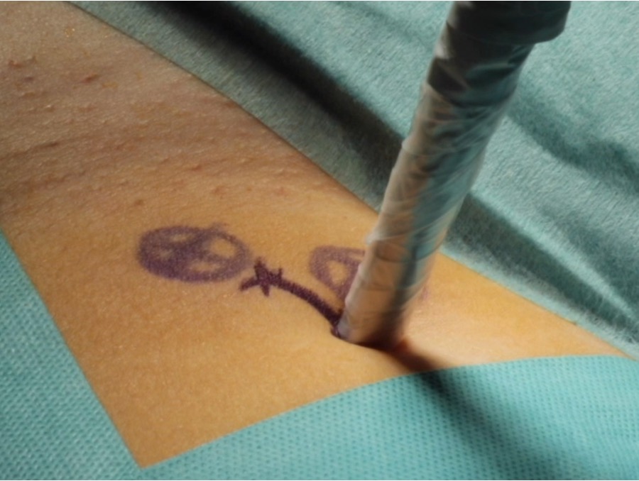 Biopsia selectiva del ganglio centinela en un paciente con melanoma
