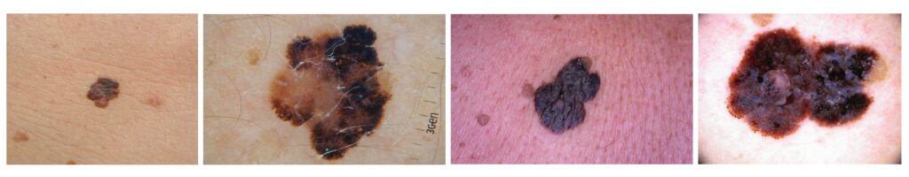 Ejemplos clínicos y dermatoscópicos de melanoma para su diagnóstico