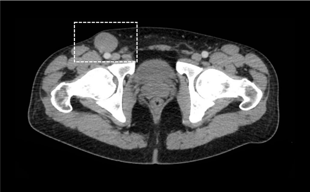 TAC para estudio de extensión en un paciente con melanoma