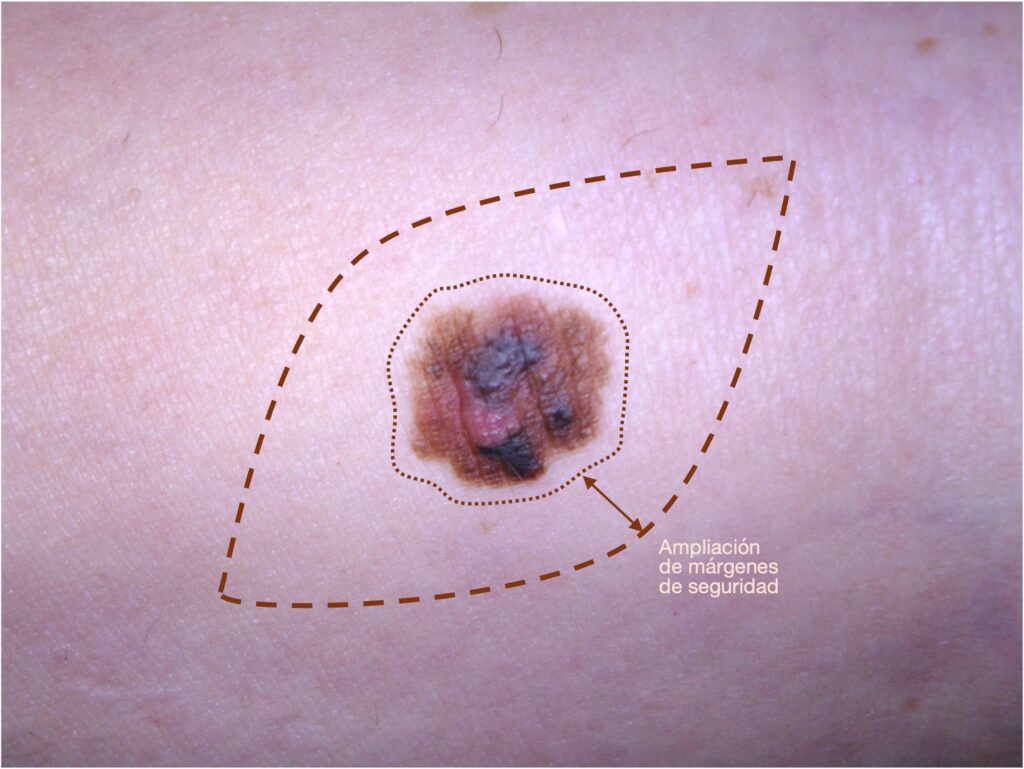 Melanoma cutáneo antes del tratamiento quirúrgico. Ampliación quirúrgica de márgenes tras el diagnóstico de melanoma