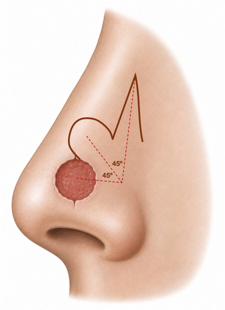 Planificación de la reconstrucción nasal tras la extirpación de un cáncer de piel